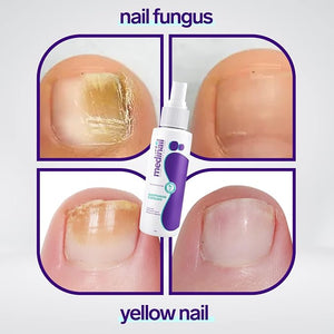 Jaysuin - Nail Fungus Spray (Original)